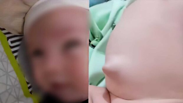 Com duas hérnias, bebê de 6 meses precisa de cirurgia e não consegue vaga em Campo Grande